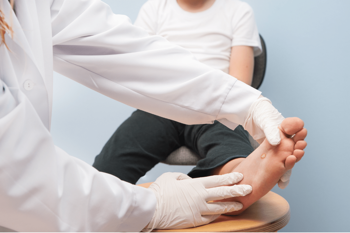Comment enlever une verrue ? Seret Medecine