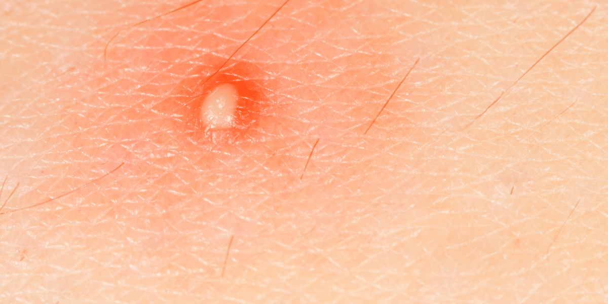 Comment faire mûrir un furoncle ? Seret Medecine